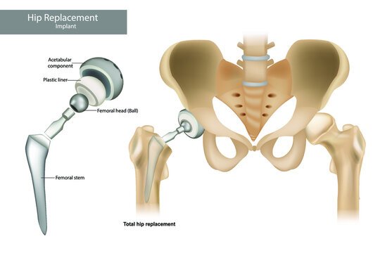 Hip Replacement Surgery in Sahibabad