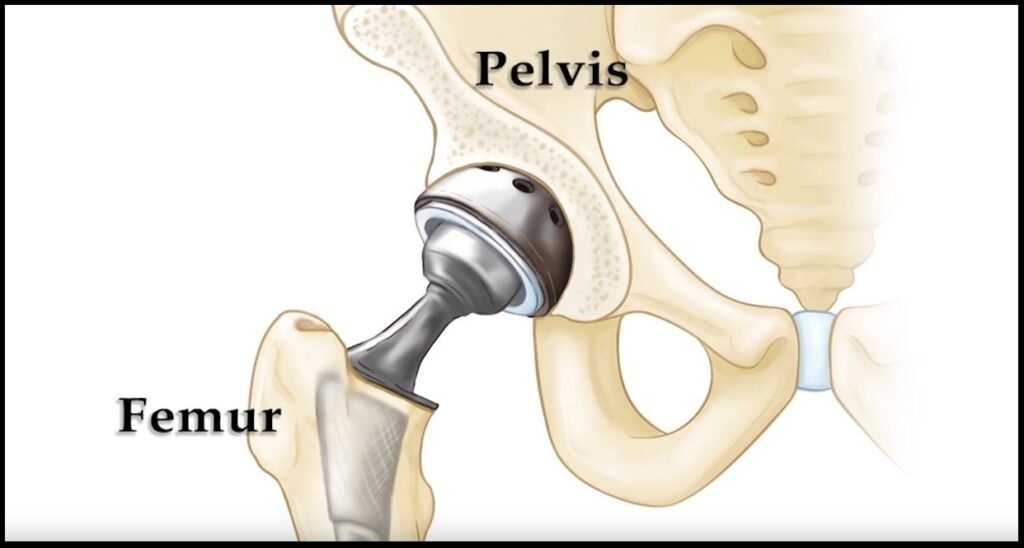 Hip Replacement Surgery in Rajendra Nagar Ghaziabad