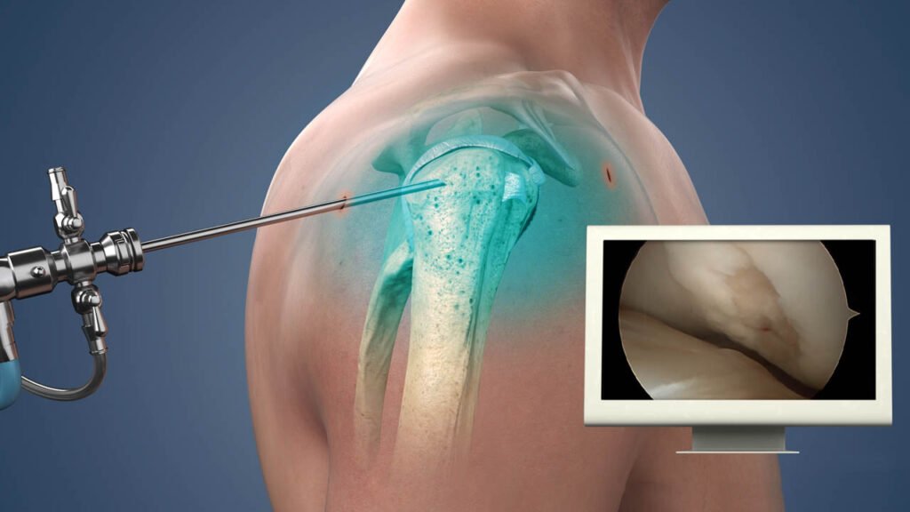 Shoulder Surgery in Rajendra Nagar Ghaziabad