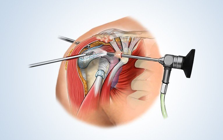 Best Shoulder Surgery in Lajpat Nagar